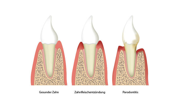 Parodontitis durch Zahnfleischentzündung 