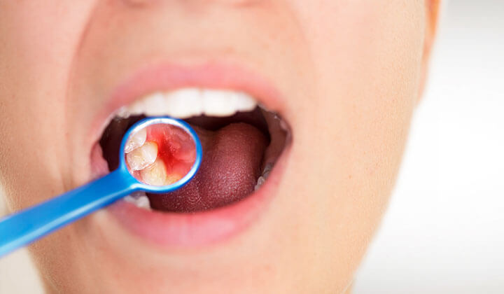 Probleme mit der Mundschleimhaut      